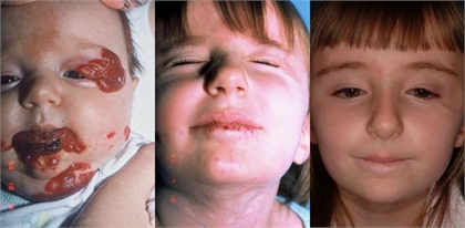 Hemangioma--.jpg